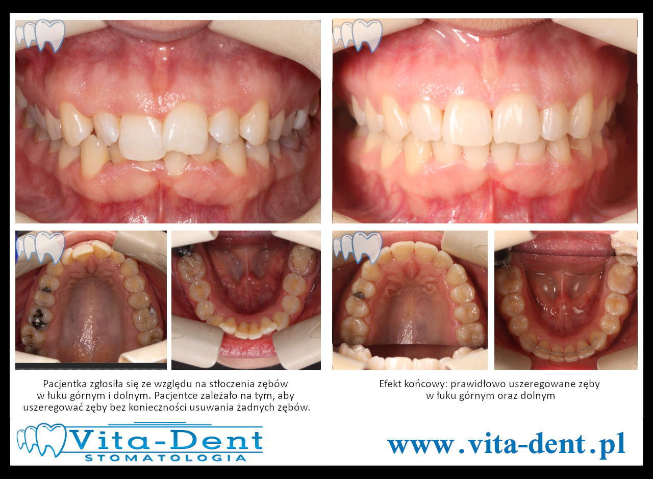 Efekt leczenia stłoczeń zębów – po terapii ortodontycznej 